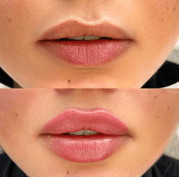 VOLUME NATUREL DES LÈVRES